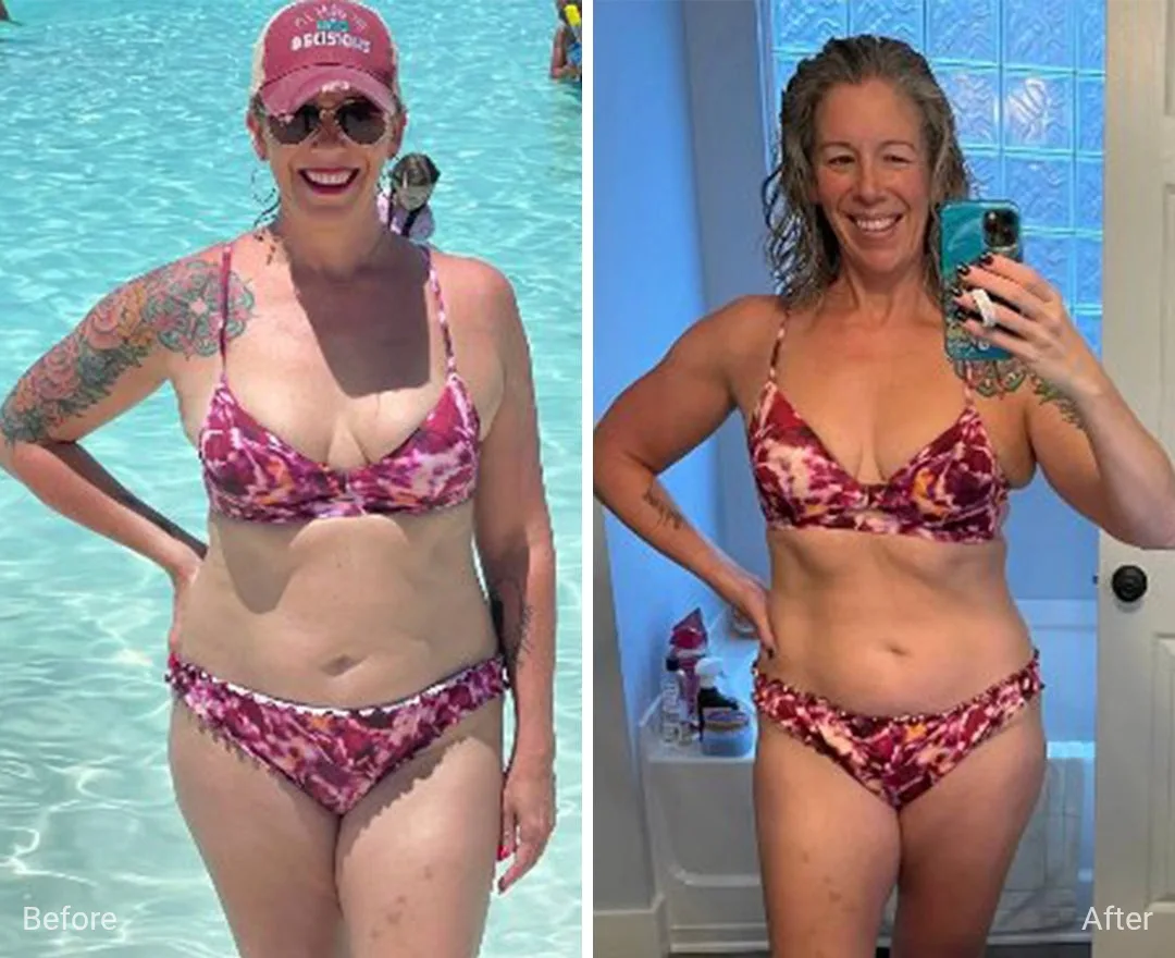 Real client before and after fat-freezing body contouring